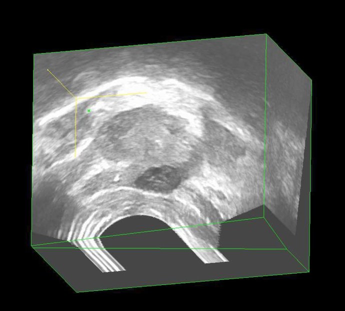 3D Sonografie der Prostata