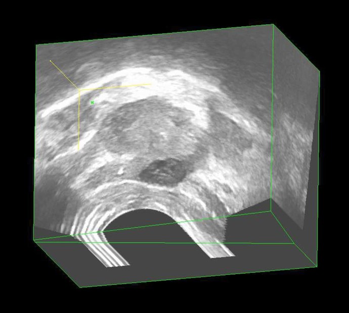 3D-Prostata Ultraschall Diagnostik eines Prostatakarzinoms