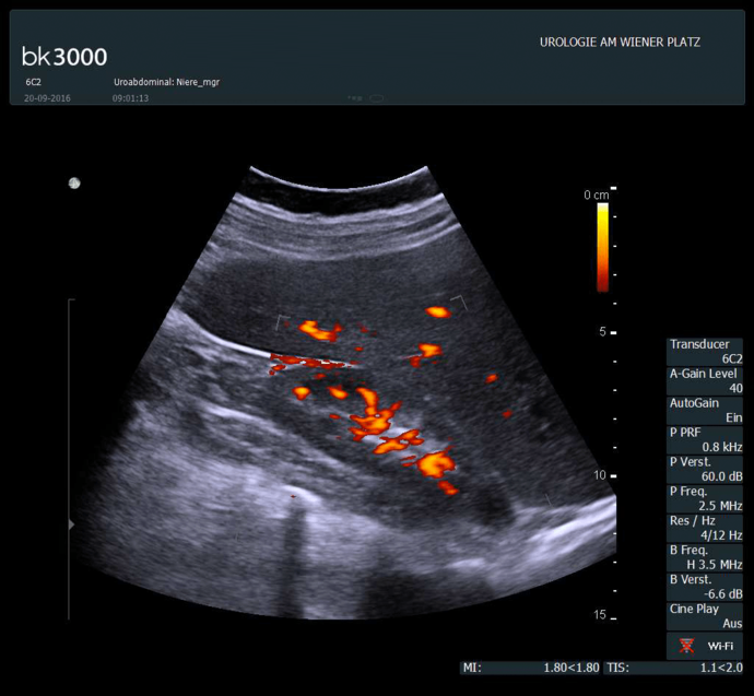 Ultraschall eines entzündeten Niernbeckens