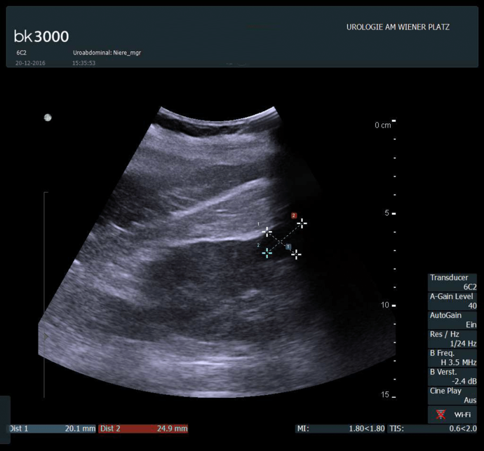 Ultraschallbild einer Nierenzyste